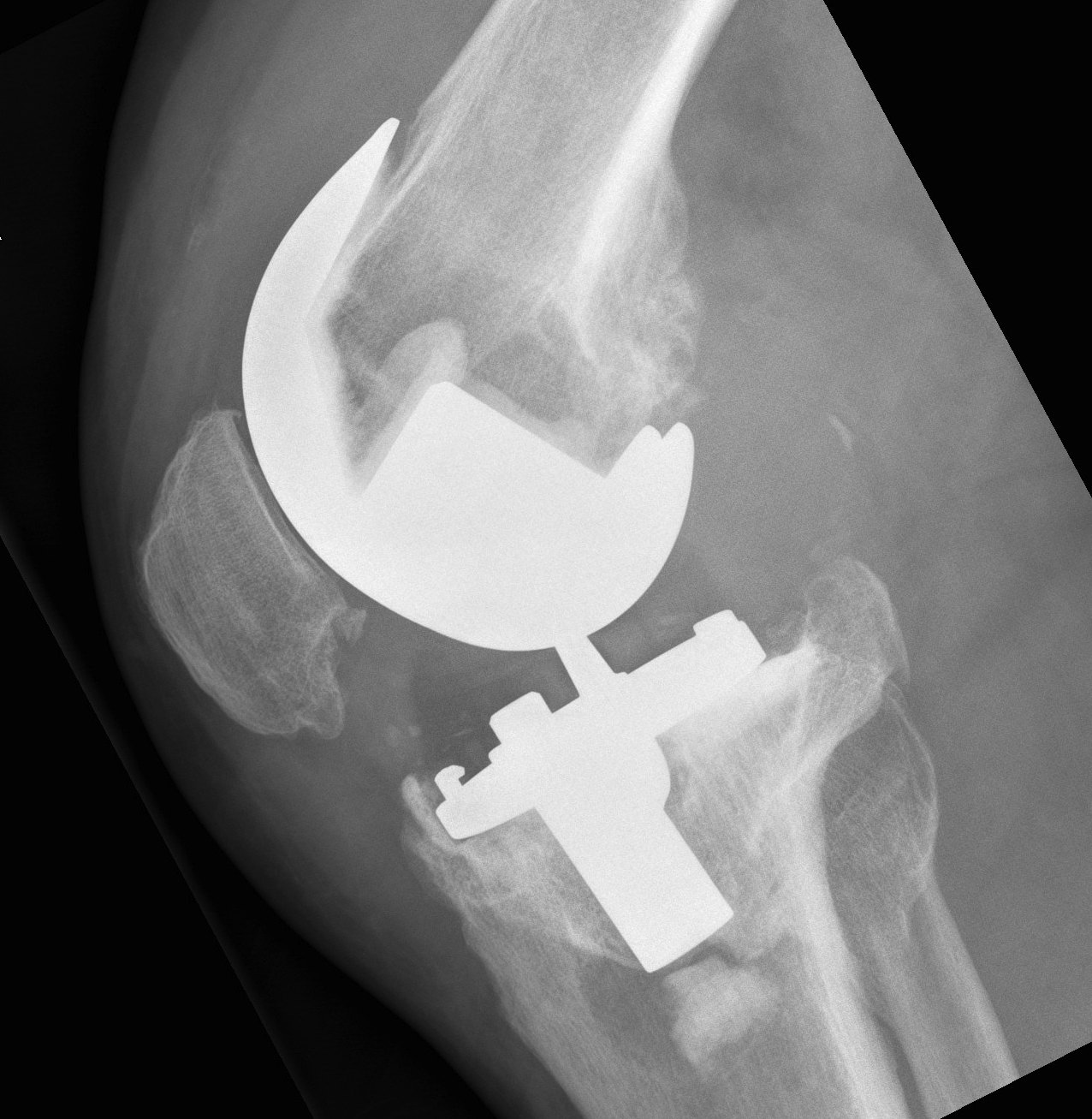 TKR CCK failing as no stems Lateral